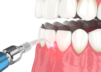 Illustration of laser being used to treat the gums