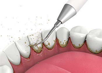 Illustration of dental instrument scaling teeth