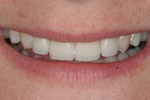 woman patient before teeth whitening