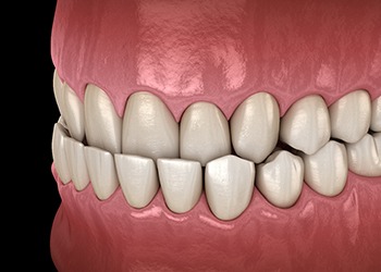 Illustration of underbite