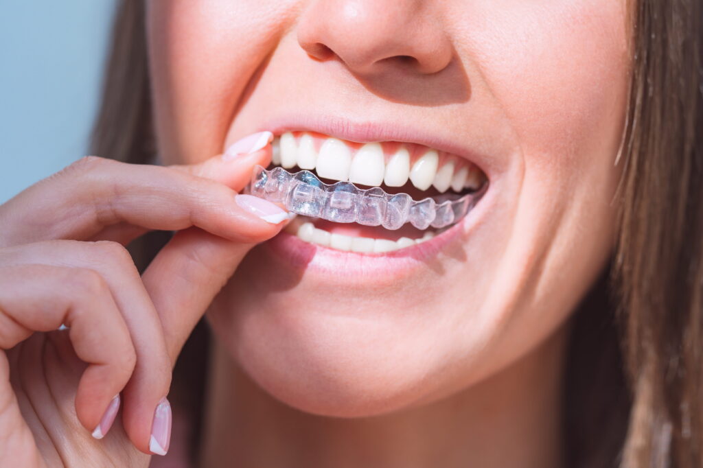 Clear Aligners for Teens: How the System Works for Younger Smiles