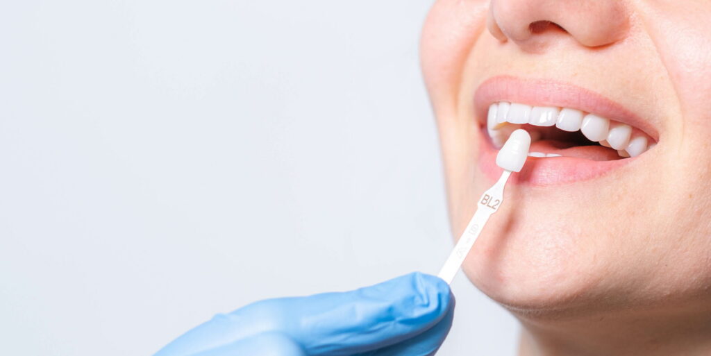 Quick Smile Fix: How Many Appointments Are Needed for Your Veneers?
