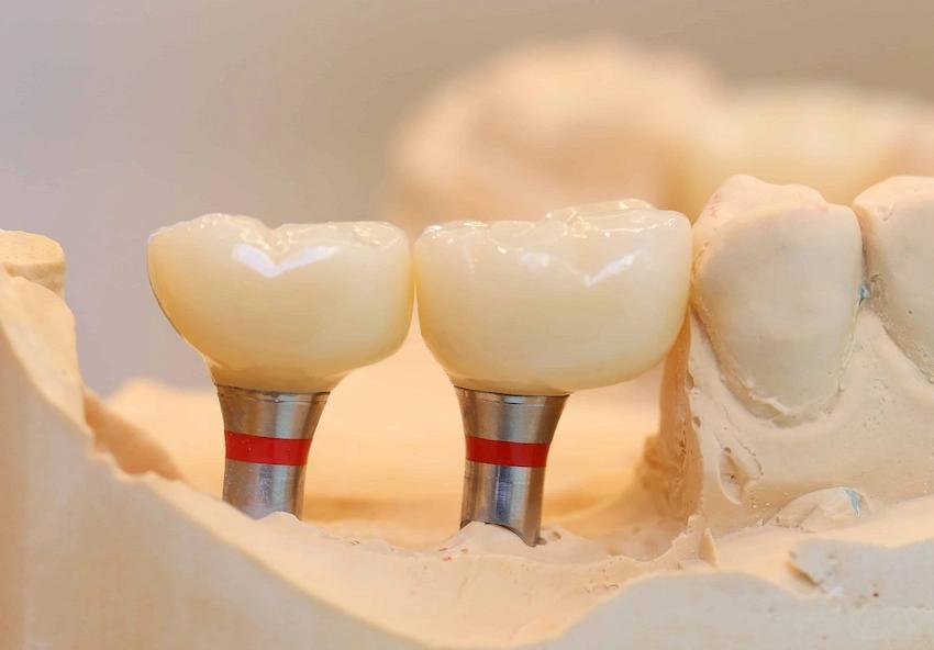 dental implants cost in moses lakes